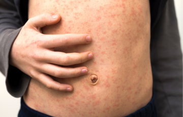 picture of person with measles on skin